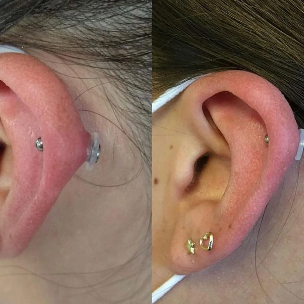 ZS 6-200 teile/los Silikon Piercing Heilung Scheiben Set Flexible Anti Hyperplasie Flache Klare Medizinische Silikon Disc 3/5/7/9 MM – Detail 4