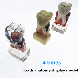 Dental Teeth Model 4 times tooth pathology model Comprehensive Periodontal Model For Teaching Study model