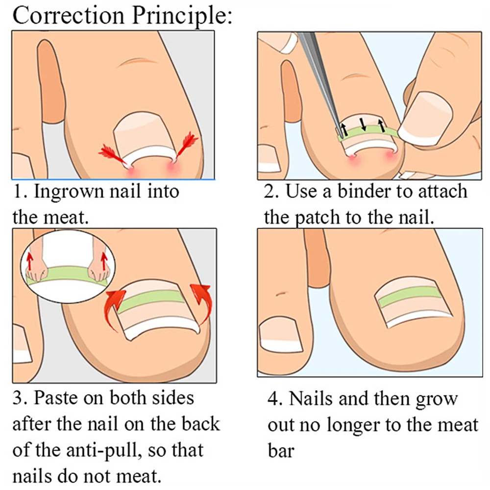 Ingrown Nail Straightener Correction Sticker Elastic Patch Sticker Ingrown Toenail Correction Resistance Claw Correction Machine