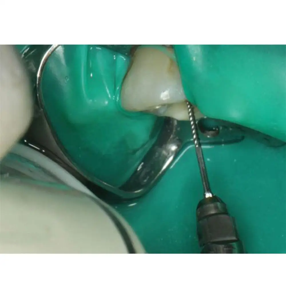 AZDENT Dental U Files Canal Root Canal Ultrasonic Opcjonalne rozmiary używane do endodontycznego czyszczenia korzeni 15-40 #   33 mm 6 szt./op.