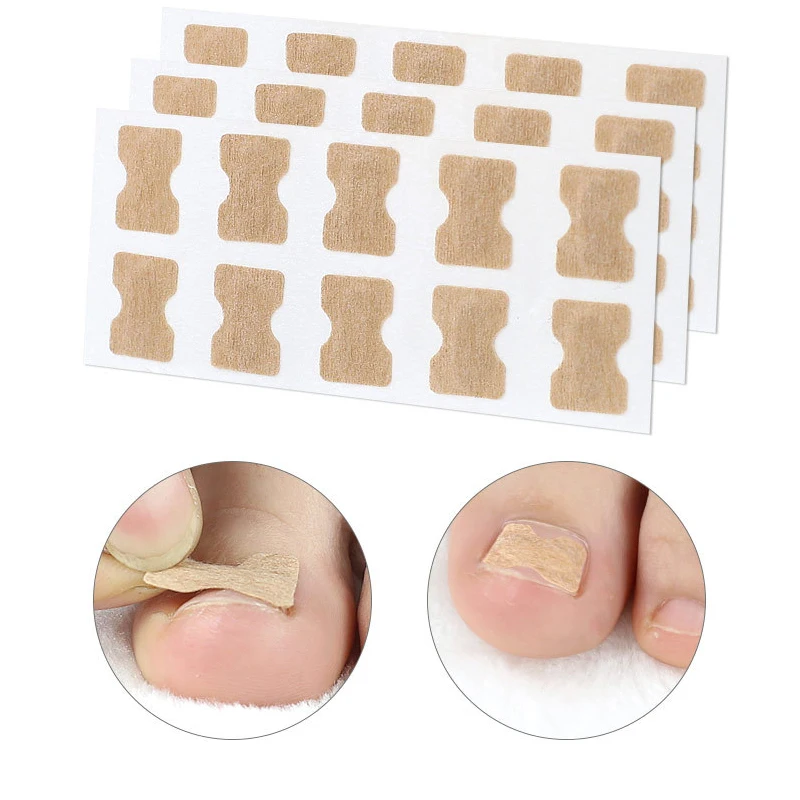 10/30/50/60 Stuks Ingegroeide Teennagel Correctie Sticker Nail Ingegroeide Correctie Patch Paronychia Corrector Pedicure Gereedschap