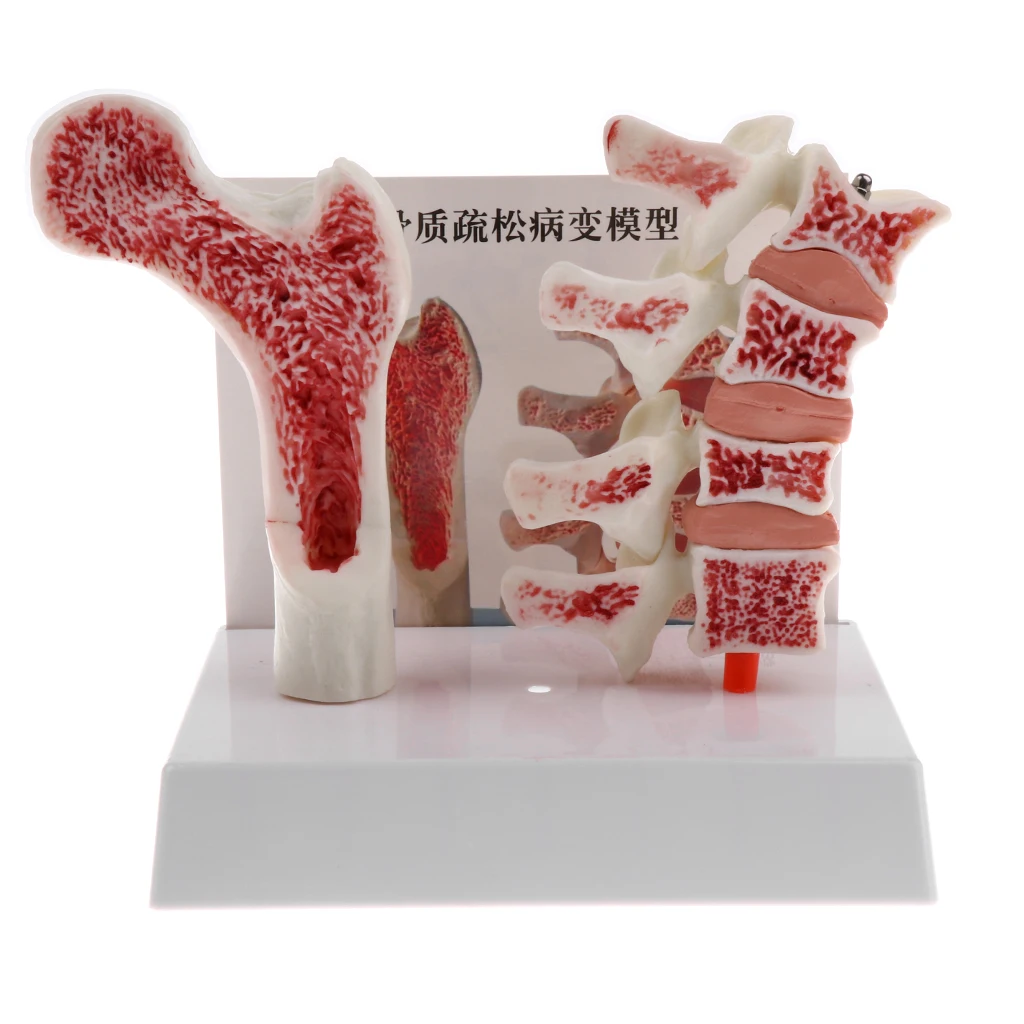 1:1 Anatomical Human Lumbar Vertebra Thighbone Model, Osteoporosis Skeleton Model, for Science Classroom Study Display