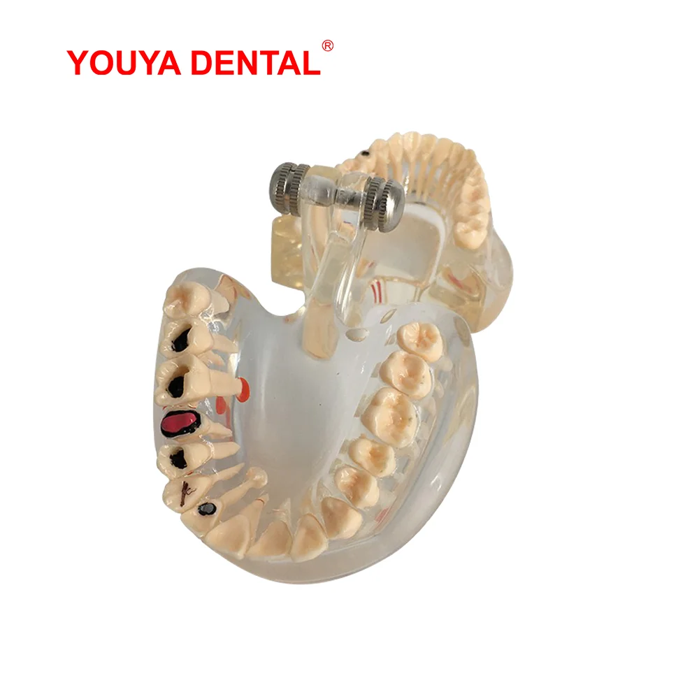 Dental Teeth Model For Studying Teaching Transparent Tooth Implant Model Adult Pathology Medical Science Oral Dentistry Products