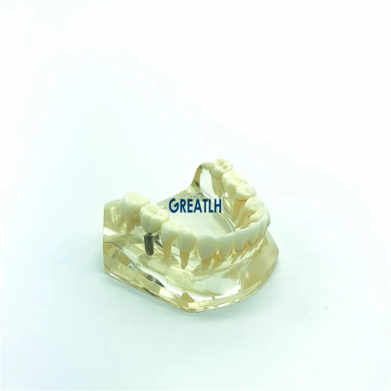 Dental implant fixtures Bridge Model Lower Jaw teeth Implant Typodont dentistry teaching model