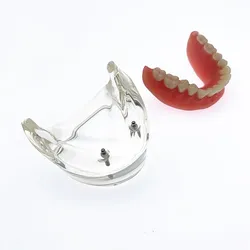 Dental Overdenture Model zębów zdejmowane wnętrze żuchwy z 2 implantami do nauczania zębów