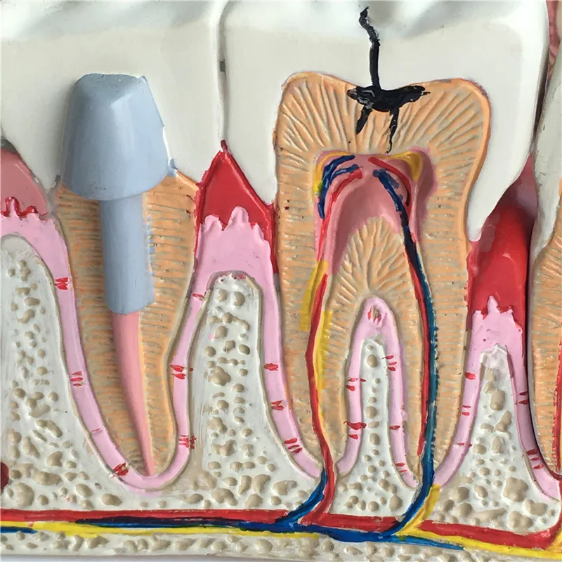 Human Tooth Common Pathologies Anatomy Model   Dental Model Medicine Teaching Instrument