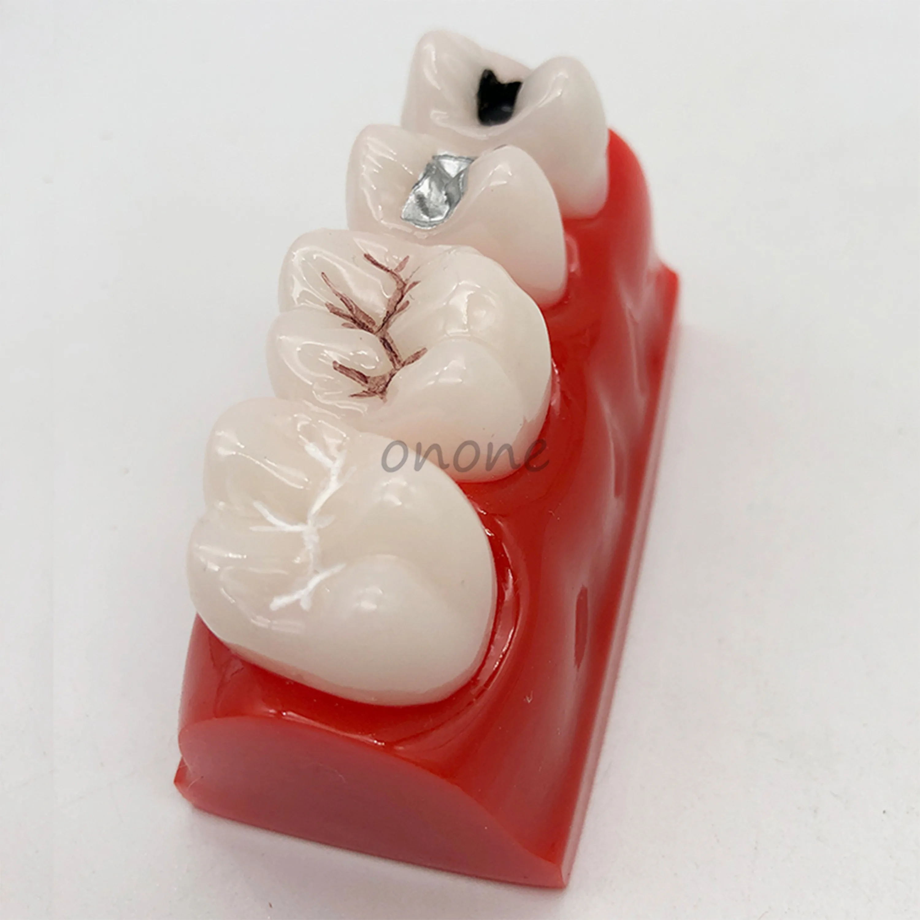 1pcs Pit and Fissure Closure Model Early Dental Caries Model Student Learning Teaching Model