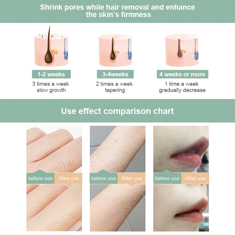 Depilador a laser permanente ipl, 990000 flashes, remoção de pelos, fotodepilador, virilha, depilador facial, corpo sem dor