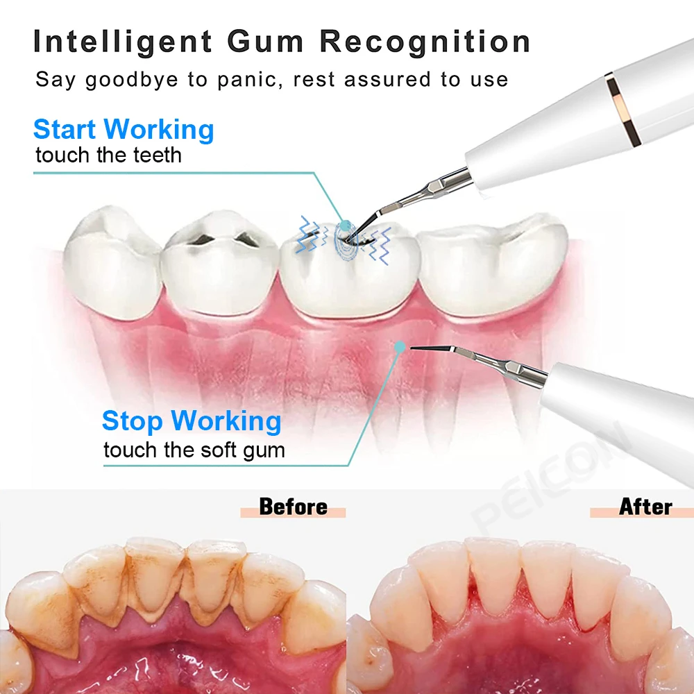 Ultra sonic Dental Scaler Für Zähne Zahnstein Fleck Zahn Zahnstein Entferner Elektrische Sonic Zähne Plaque Reiniger Dental Stein Entfernung