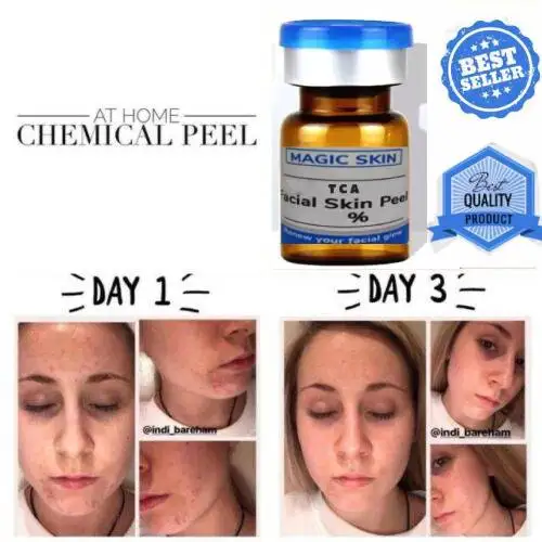 

Tca 60 Chemical Peel Skin Peel Kit Peeling Acid Age Spots Acne Pit Chloasma Tattoos Pigmentation Acne Scar Repair