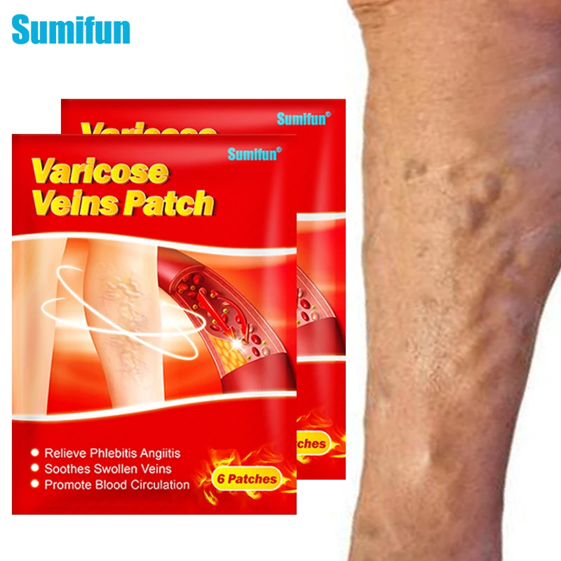 

Sumifun 6pcs/bag Varicose Veins Patch Leg Vasculitis Phlebitis Spider Leg Medical Plaster Angiitis Removal Chinese Herbal Patch