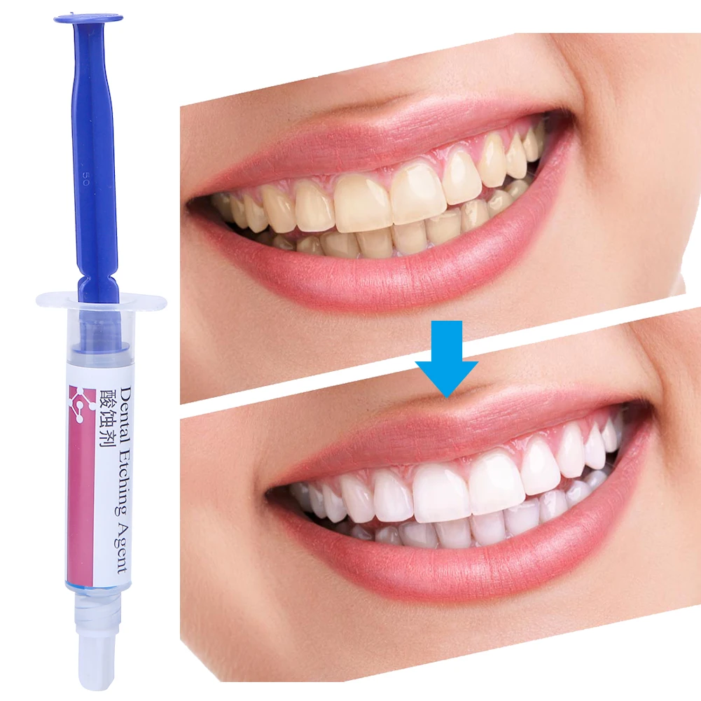 Dental Etching Agent 37% Phosphoric Acid Etch Polymer Thickened Semi-Gel Type Syringe Treat Enamel Dentin Teeth Care Kit Tools