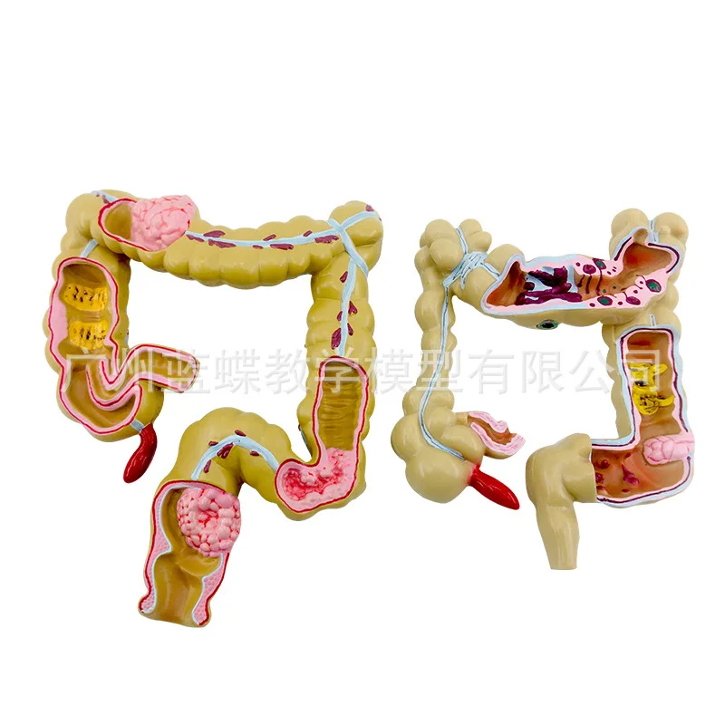 1/2 Life Size Human Rectal Pathology Colon Model Large Intestine Model Anorectal Anatomical Model Tools