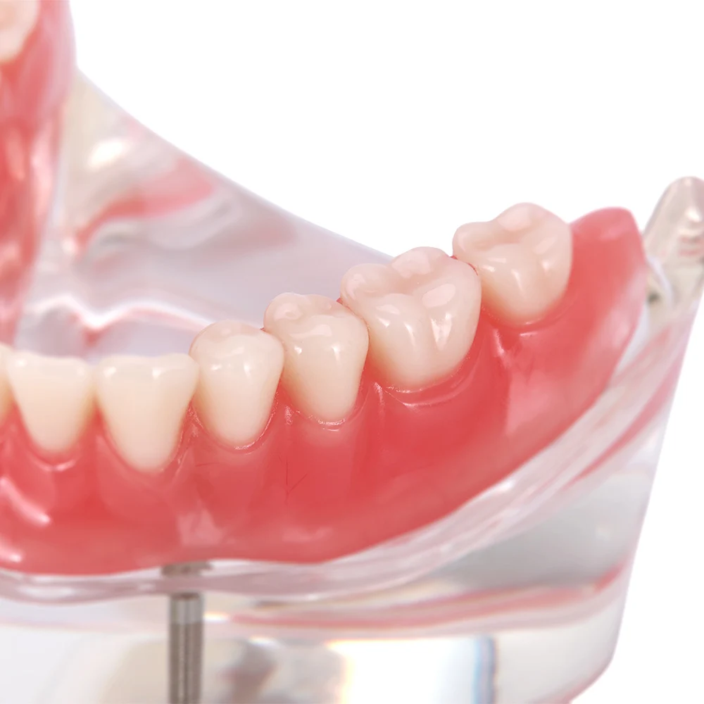 Dental Overdenture zęby Model nauczania zdejmowane wnętrze żuchwa z implantem tylko do celów demonstracyjnych