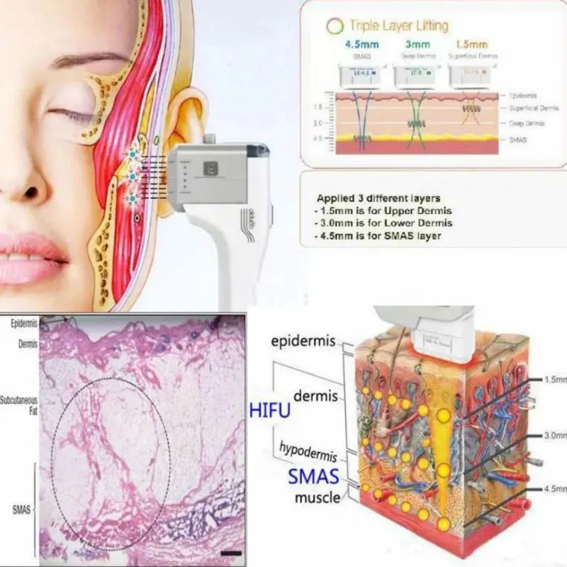 ثلاثية الأبعاد 4D ماكينة الموجات فوق الصوتية عالية التكثيف المركزة خراطيش 20000 طلقات الوجه الجلد رفع التجاعيد إزالة الجسم التخسيس