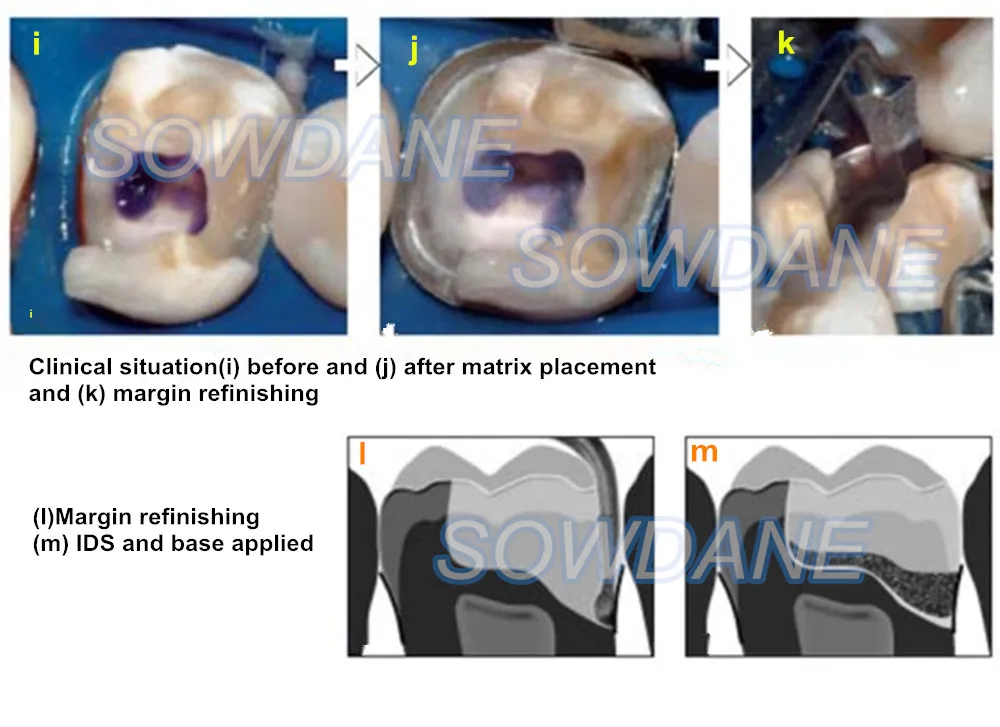 Dental Tofflemire Matrix for Deep Margin Elevation Large Curvature Matrices Retainer Sectional Contoured Matrice Dental Material