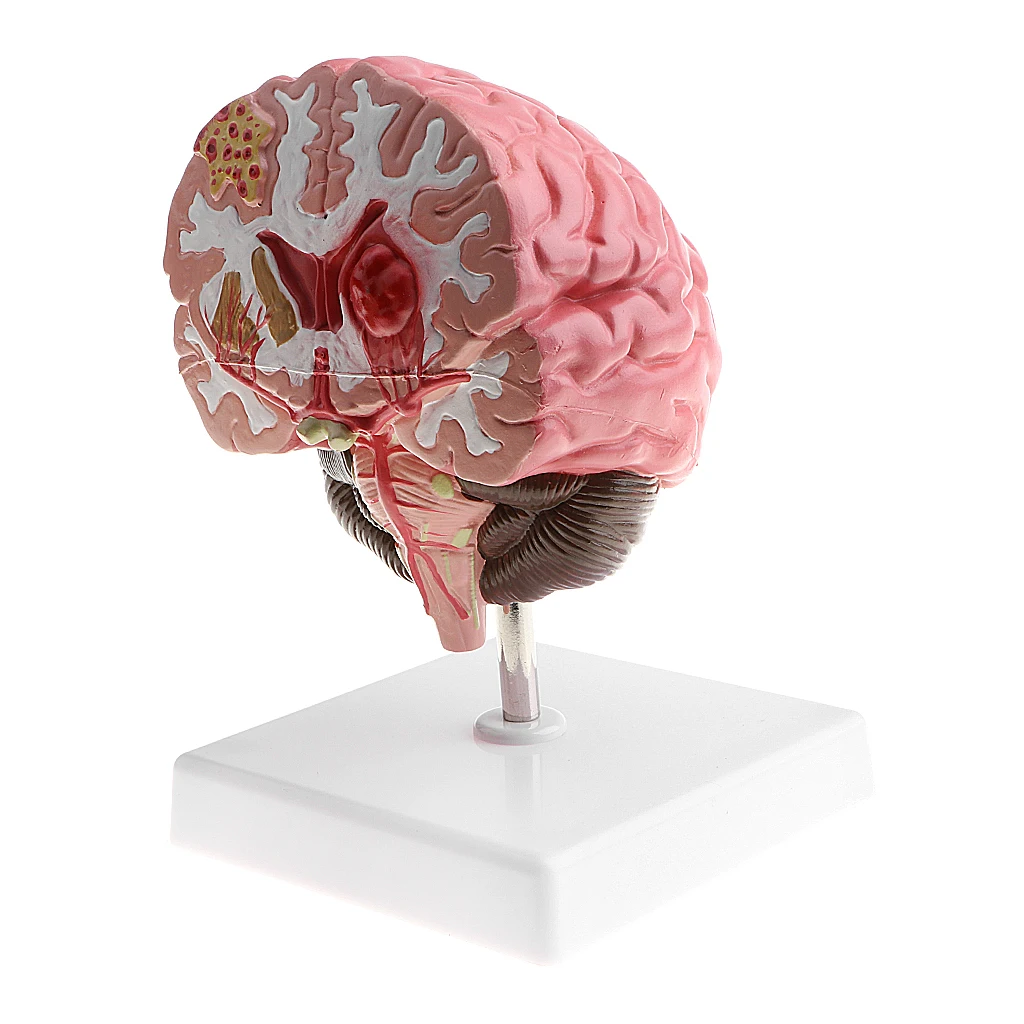 Anatomical Human\'s Brain Disease Pathological Model Medical Teaching Tool Lab Display Model School Educational Brain Model