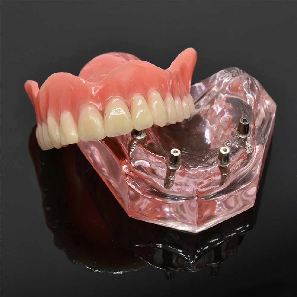 Modelo Mandibular Dental Removível com Implante, Dentes Overdenture, Dentes Superior e Inferior, Dente Ensino e Estudo