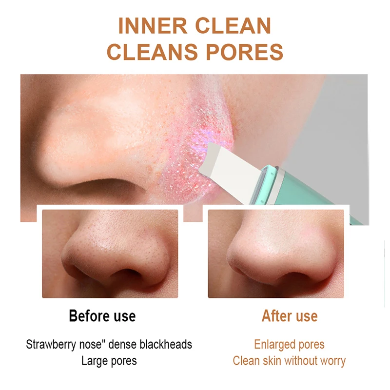 Limpiador ultrasónico para la piel, espátula Facial con vibración, eliminador de espinillas, pala de limpieza, Peeling de cavitación