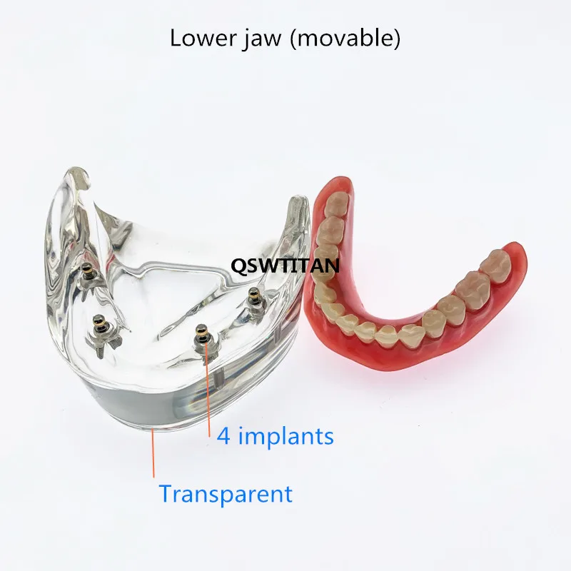 Model zębów dentystycznych z implantem Overdenture gorszy model zębów żuchwowych Model badania