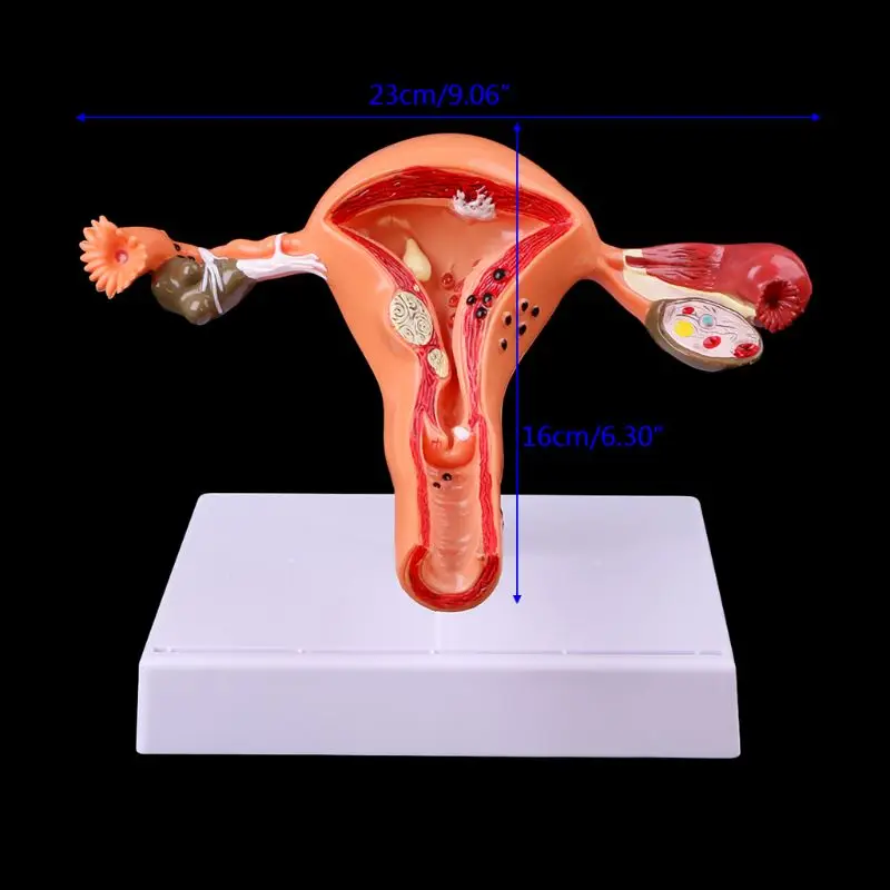 Medizinische requisiten modell Freies porto Pathologischen Gebärmutter Eierstock Anatomisches Modell Anatomie Kreuz Abschnitt Studie Werkzeug