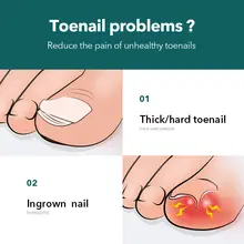 Stainless Steel Ingrown Toenail Clippers #3