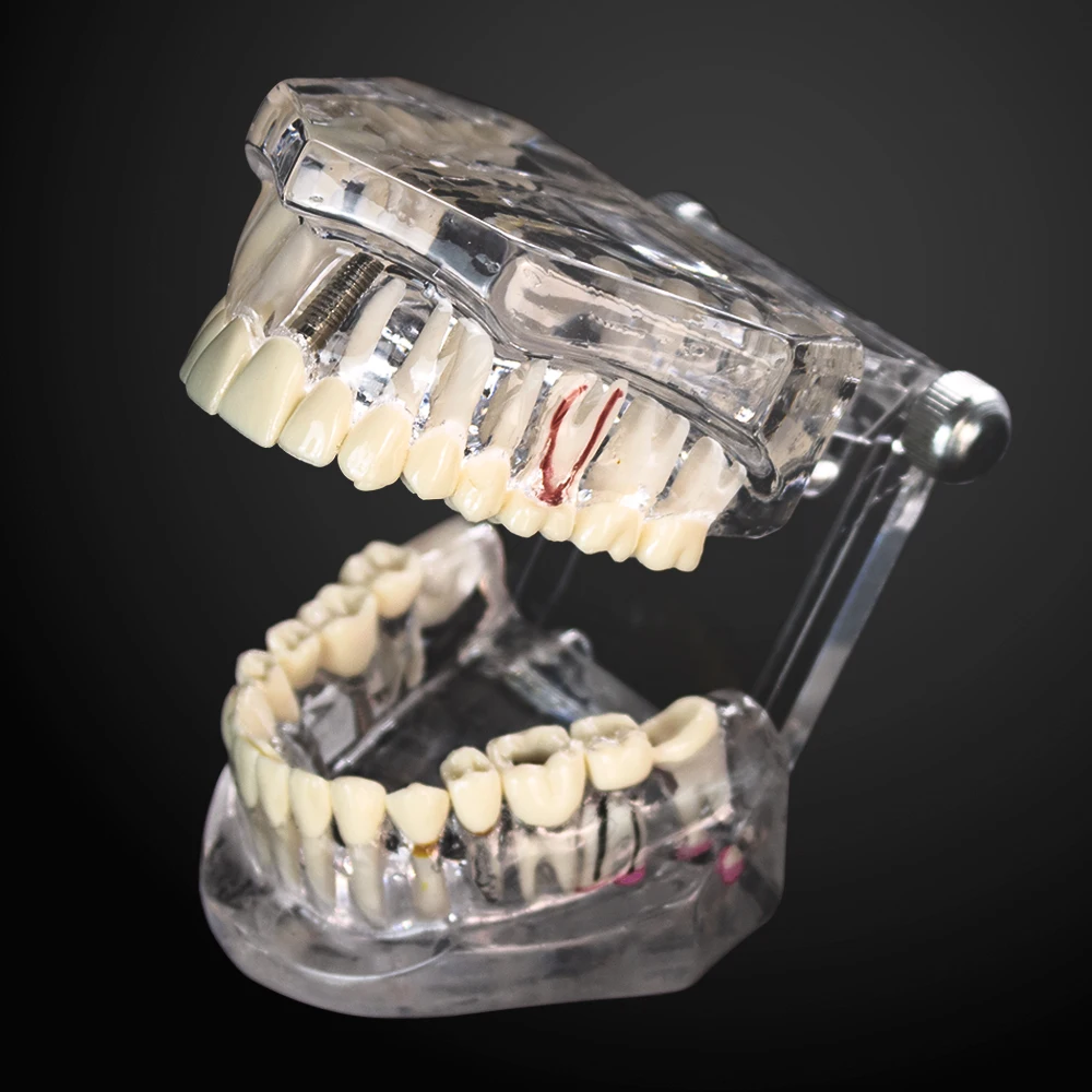 Transparent Disease Dental Model Teeth Implant Restoration Bridge Teaching Study Tooth Dentist Research Communication