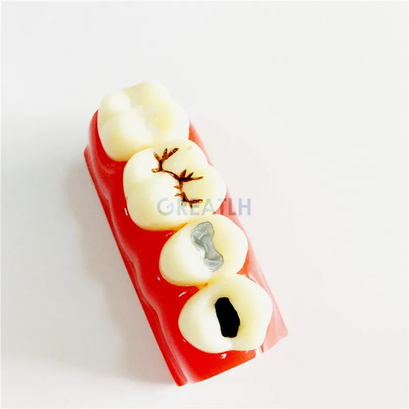 

Fissure SealingandDental Pit Treatment Teeth Tooth Study Learn Model