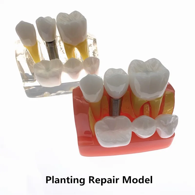 

Dental 4 times planting Teeth model Analysis Crown Bridge Removable Model Dental Teaching Research Model