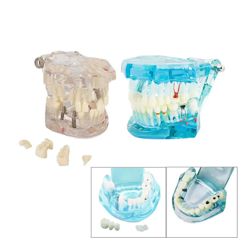 Dents de modèle de mâchoire orthodontique pour l\'étude de la dentisterie, fuchsia, dentiste, produits et accessoires, 41 styles