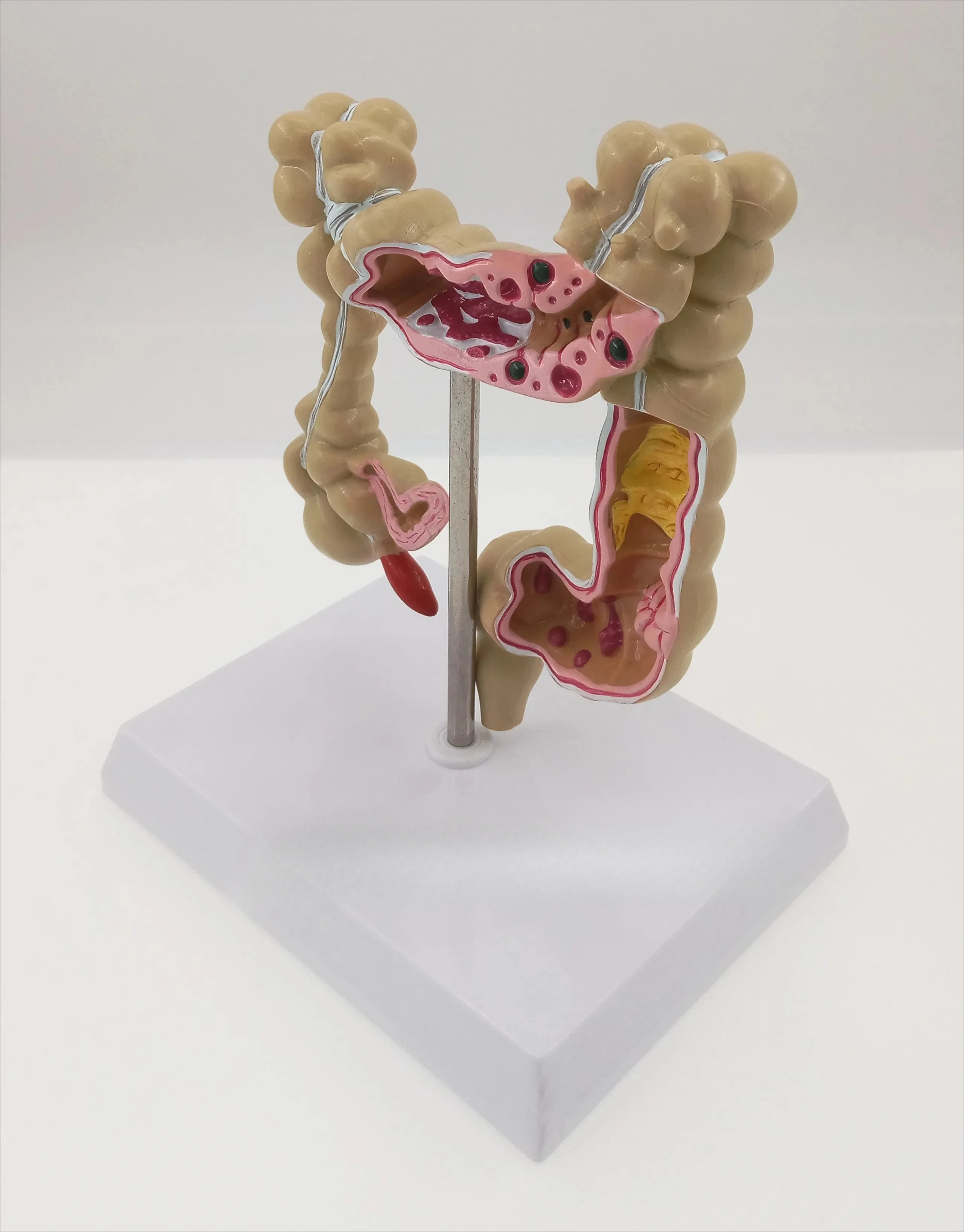 

патологическая модель толстой кишки, колоректальные поражения, образец кишечника, анатомия толстой кишки, обучающая модель
