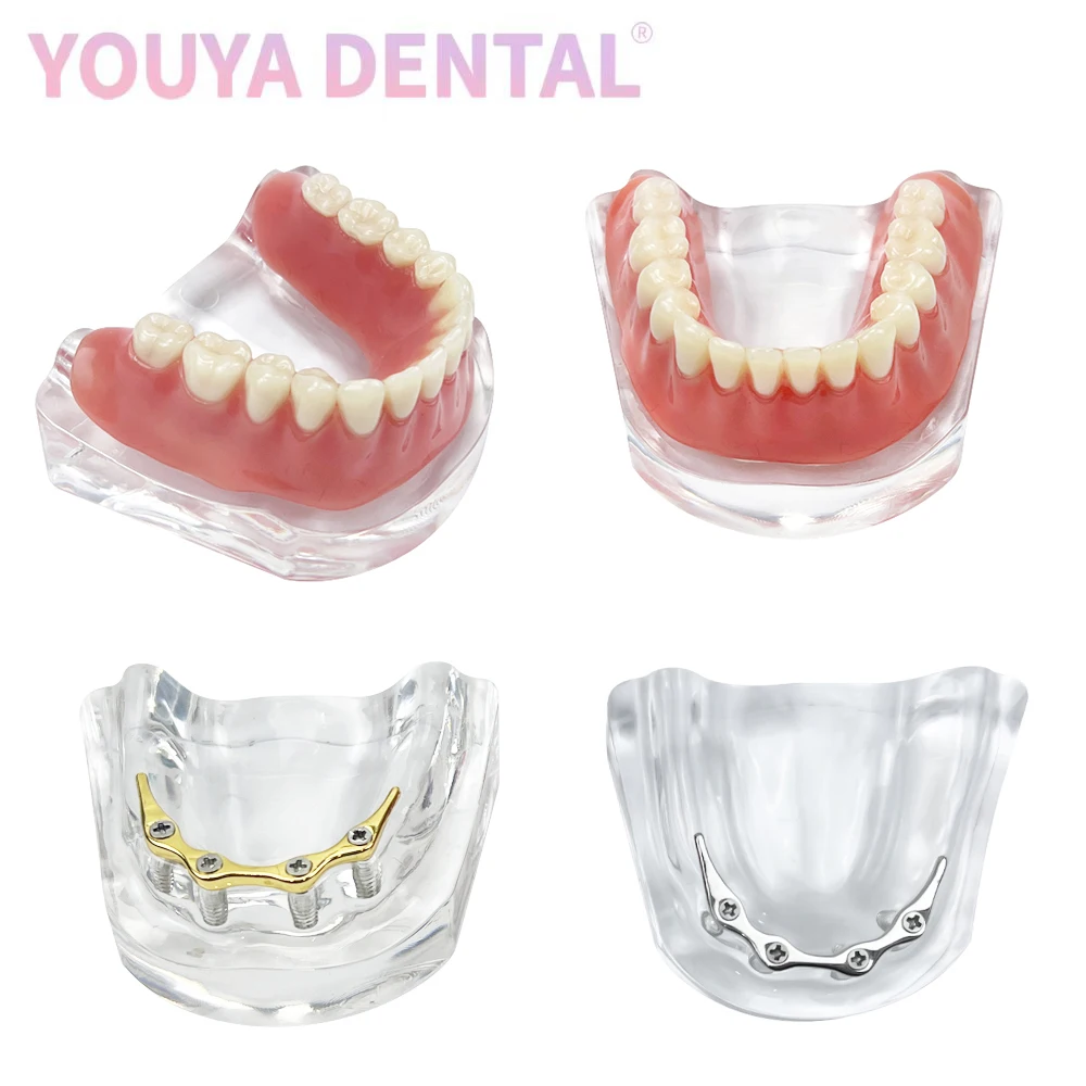 

1Pcs Dental With 4 Implant Nails Mandibular Repair Tooth Model Removable Dental Bridge Typodont Treatment Model Dentist Teaching