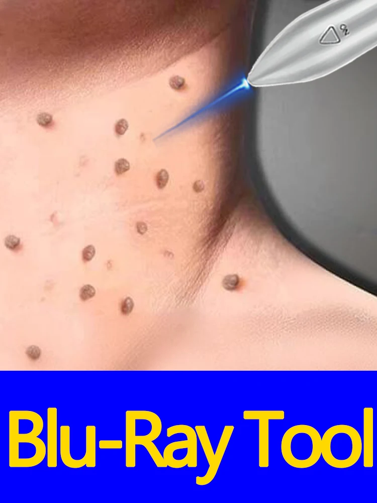 

5-in-1 tool kit solve warts Luminous tool pen blue for warts
