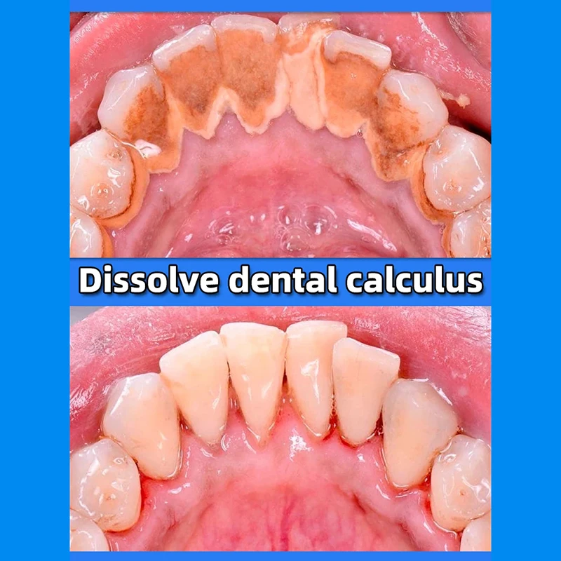 Removedor de cálculo Dental, blanqueamiento de dientes, eliminación de olores bucales, mal aliento, prevención de Periodontitis, aliento fresco, pasta de dientes para el cuidado bucal