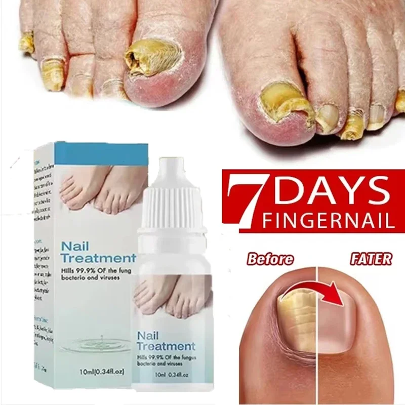 Onychomycosis Voet Reparatie Oplossing Teen Onychomycosis Verwijdering Paronychia Onychomycosis