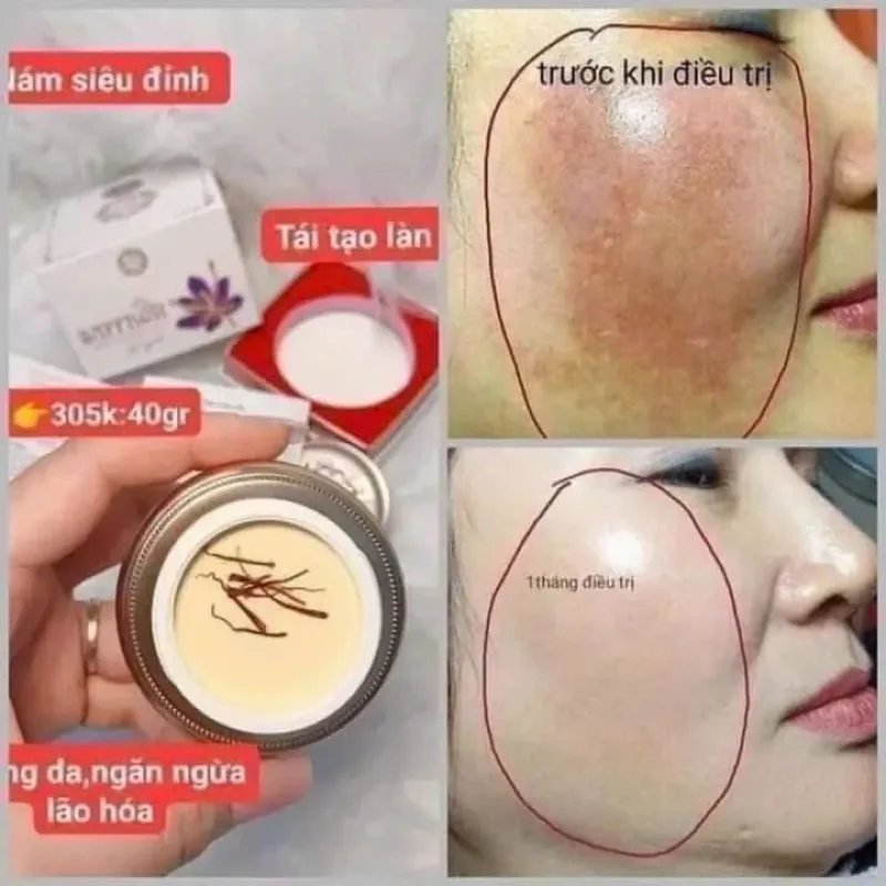 20g/botella Viet Kem Nám Tàn Nhang, para atenuar manchas oscuras, pecas, lunares, atenuar la oscuridad, nutrir y blanquear la piel, hidratar la piel