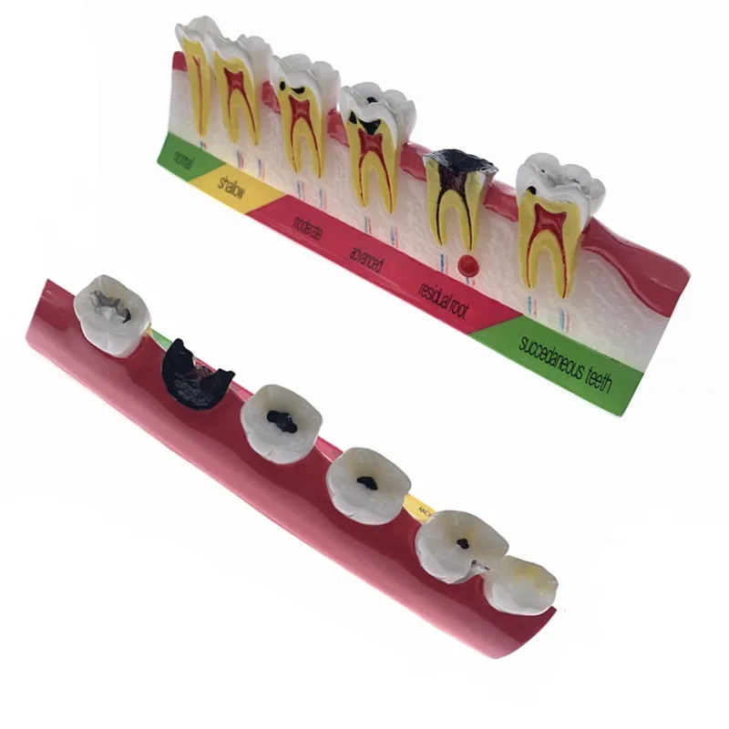 Dental Caries Classify Tooth Model of Pathological Process Around Teeth Caries Evolution Decayed Model Dentist Lab Tool