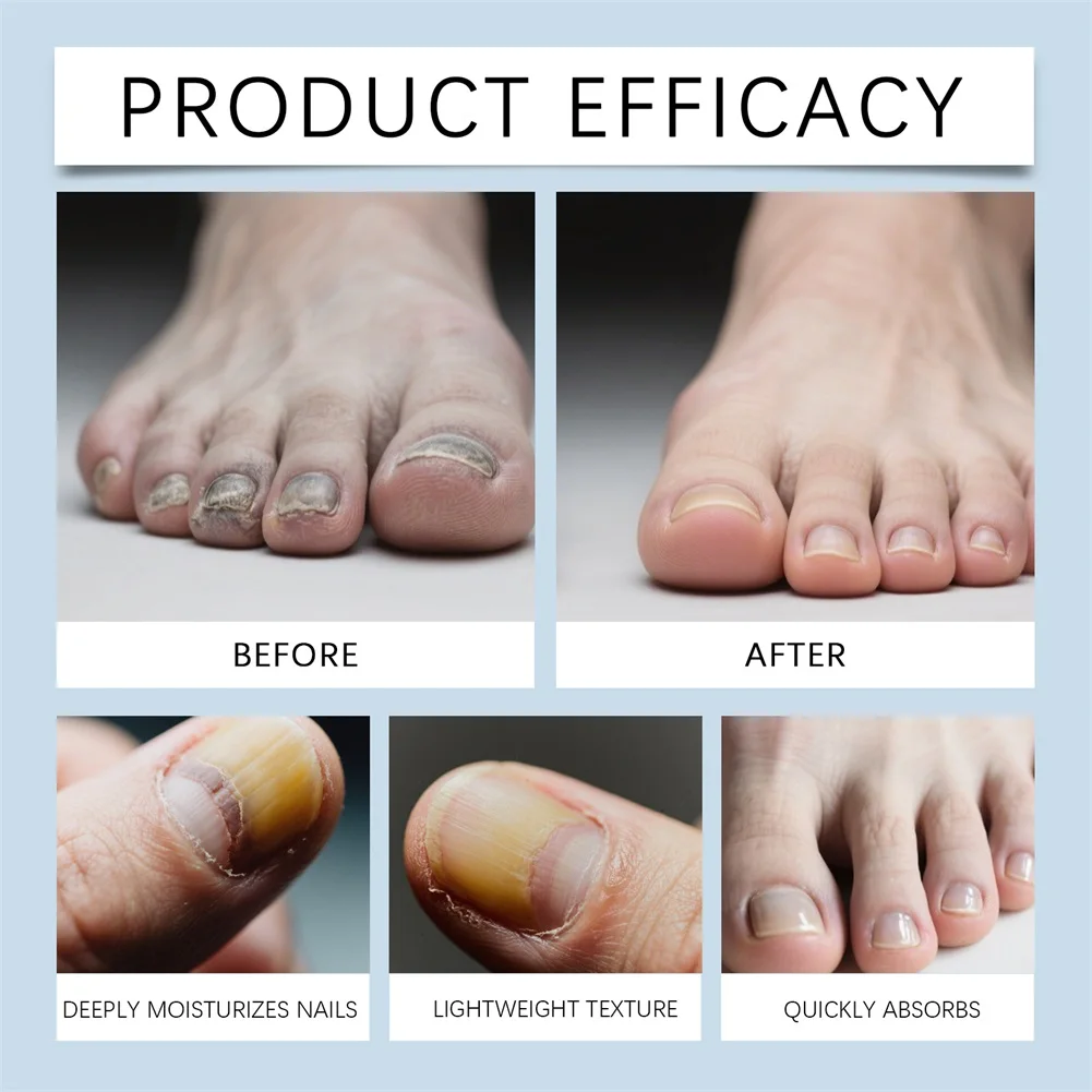 Nail-Fungus Pen Nail Growth Treatments Repair Serum Toenail-Fungus Treatments Extra Strength Nail Repair Serum Toenail Care Tool