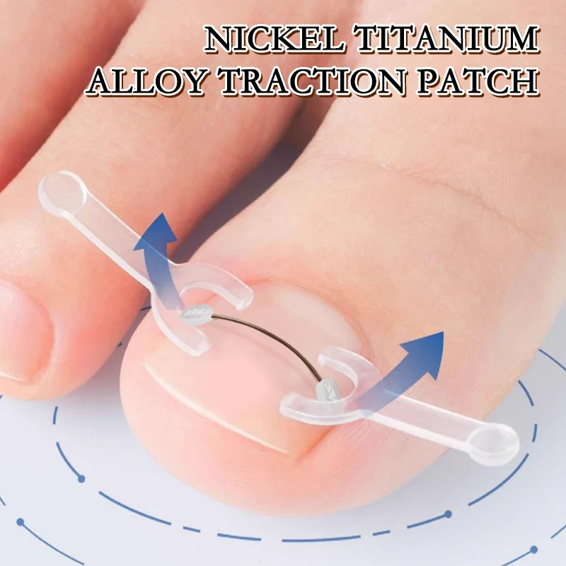 Ingrown Toenail Correction Tool Ingrown Toe Nail Treatment Elastic Patch Sticker Straightening Clip Brace Pedicure Tool