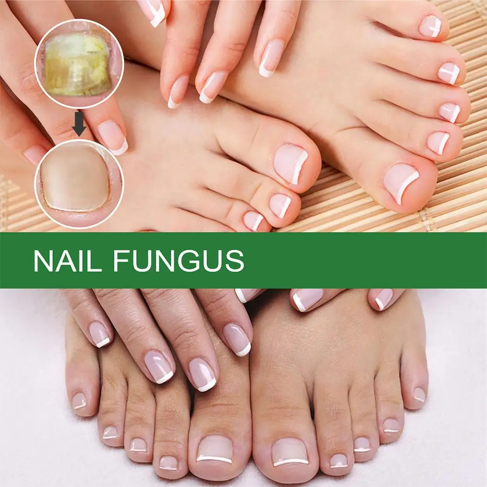 Nail Fungus Repair Liquid, Anti-infeccioso, Paroníquia, Onicomicose, Remoção Fungosa, Produtos de Saúde, 50ml