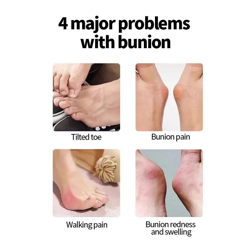 Bunion Corrector regolabile alluce valgo separatore Big Toe raddrizzatore borsite stecca correzione ossea Pedicure Unisex cura del piede