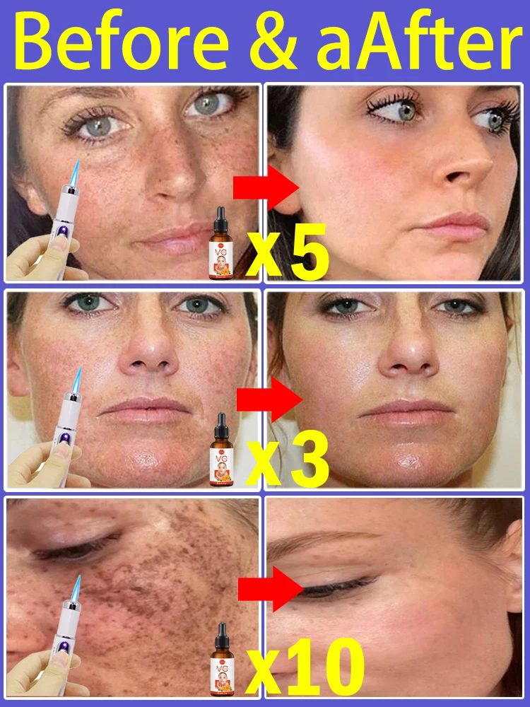 Chloasma Sun Age Pecas con manchas oscuras