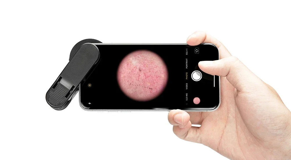 IBOOLO Electric Dermatoscope Clinical Medical Instrument For Pigmented Diseases CE Metal Dermatoscope