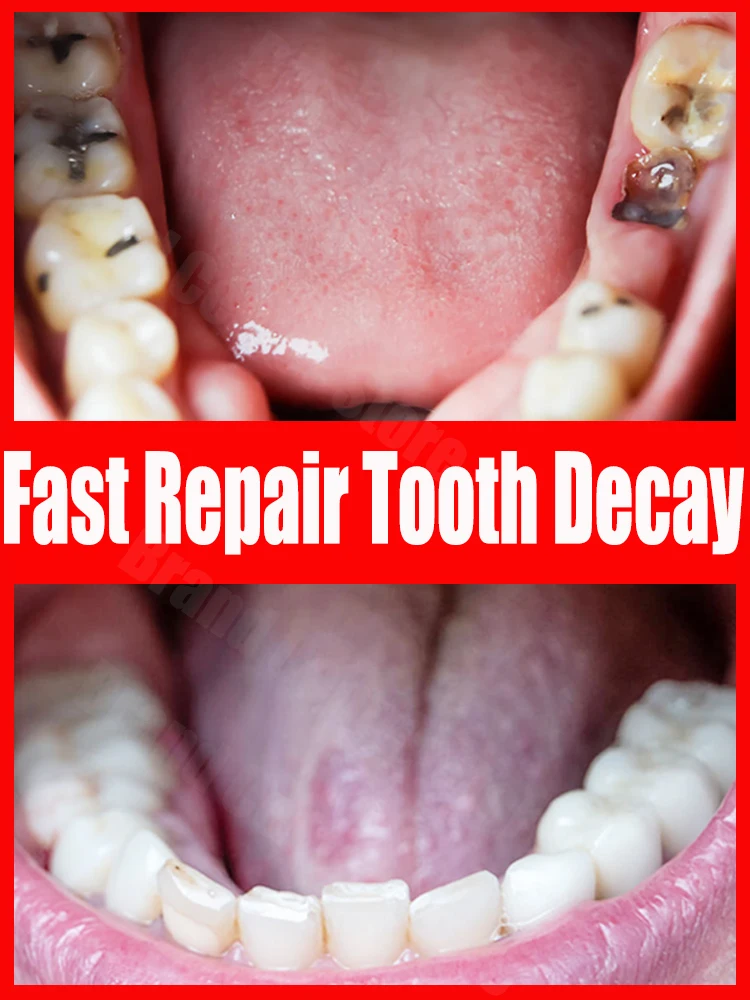 

Decay tooth cavities healing anti caries