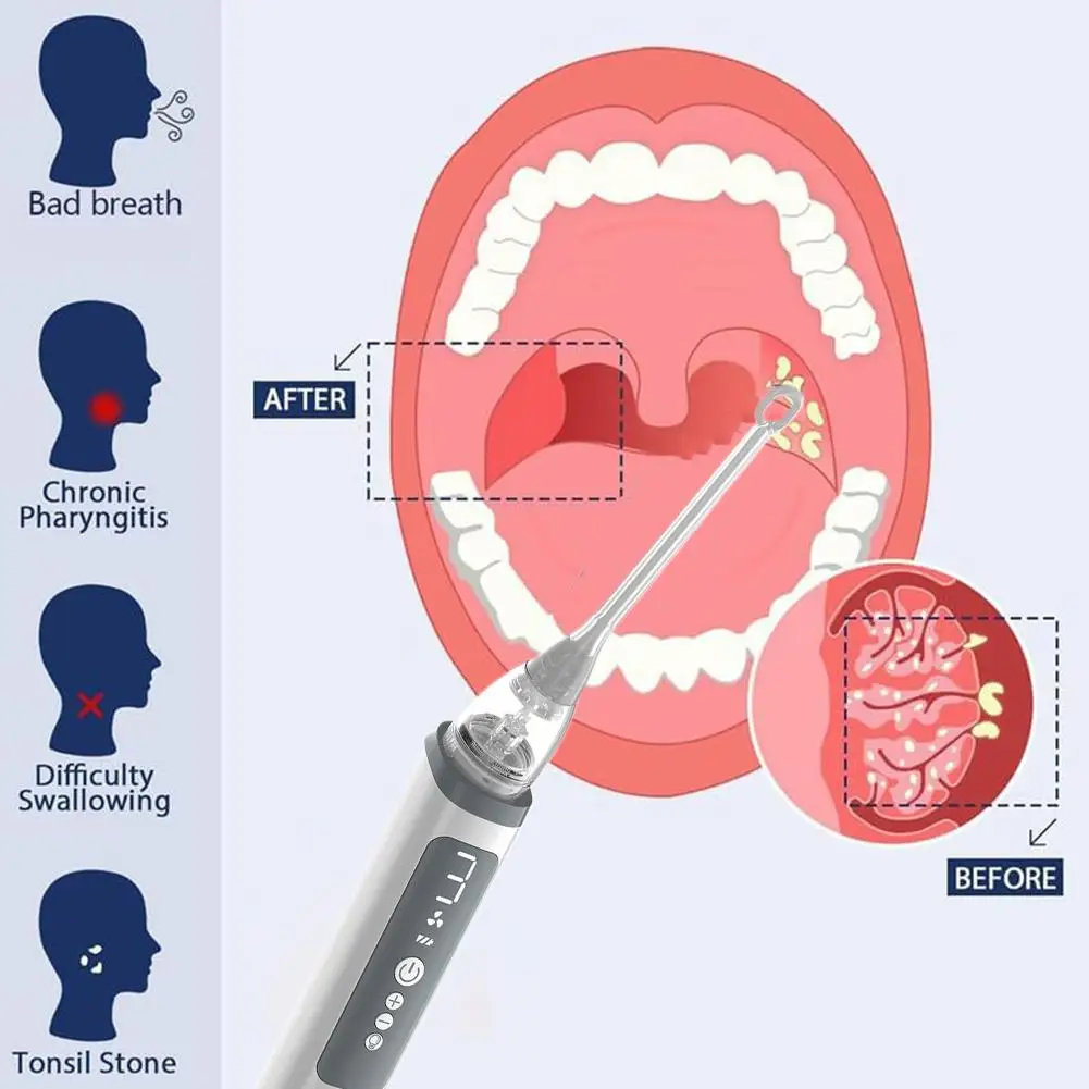

Инструмент для удаления камней из миндаля, набор для удаления камней из миндаля с насосом, пылесос для снятия пылесоса, безопасная всасывающая гигиена дыхания R6S4