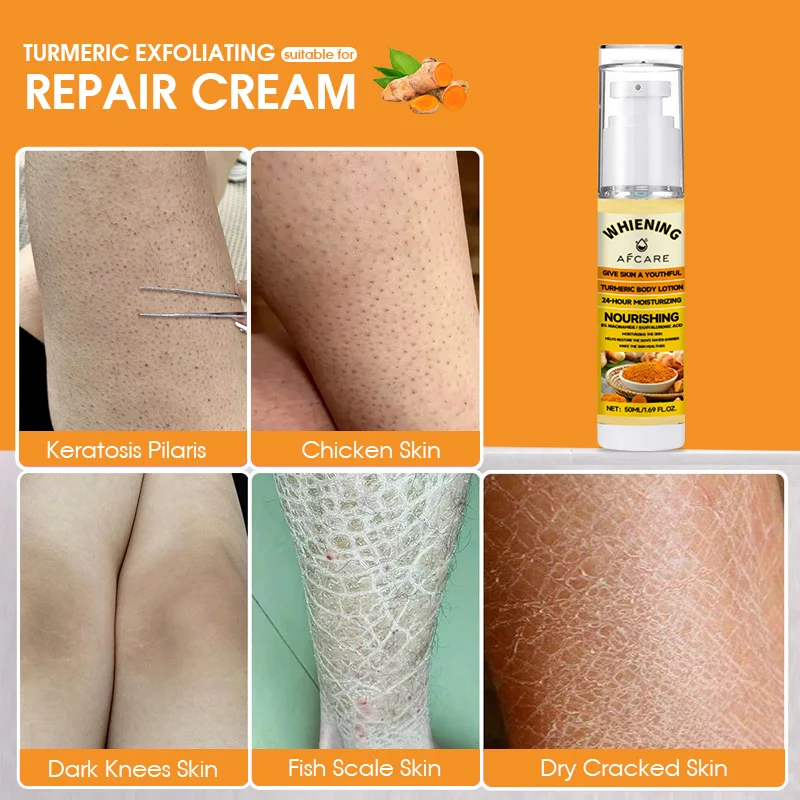 Turmeric Body Cream Treatment Keratosis Pilaris Lotion Chicken Skin Removal Rough Bumpy Moisturizer Whitening Creams Skincare