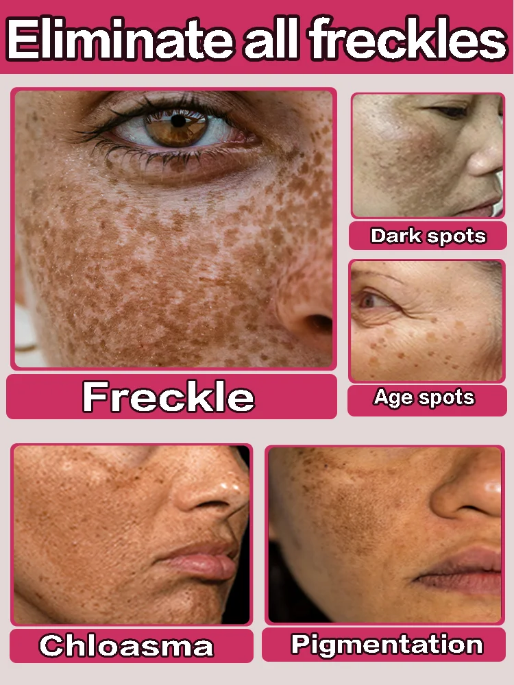 An effective facial freckle cream that removes freckles and solves the freckle problem that has existed for many years