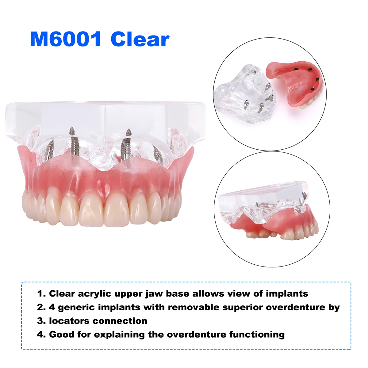 Dental Overdenture Model 4 Implants Upper Lower Jaw Hard Resin Artificial Gum Removable Denture Teaching Demo Model