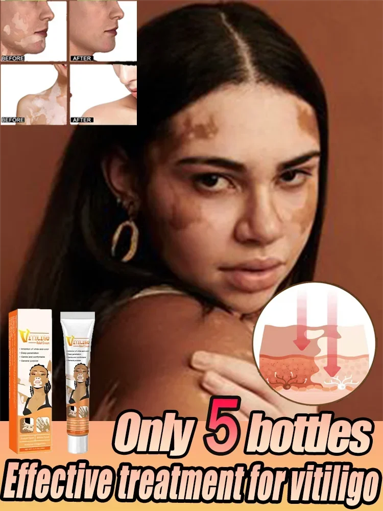 

Vitiligo Skin Cream Help Skin Treatment Melanin Promotes Pigmentation Mela Gain