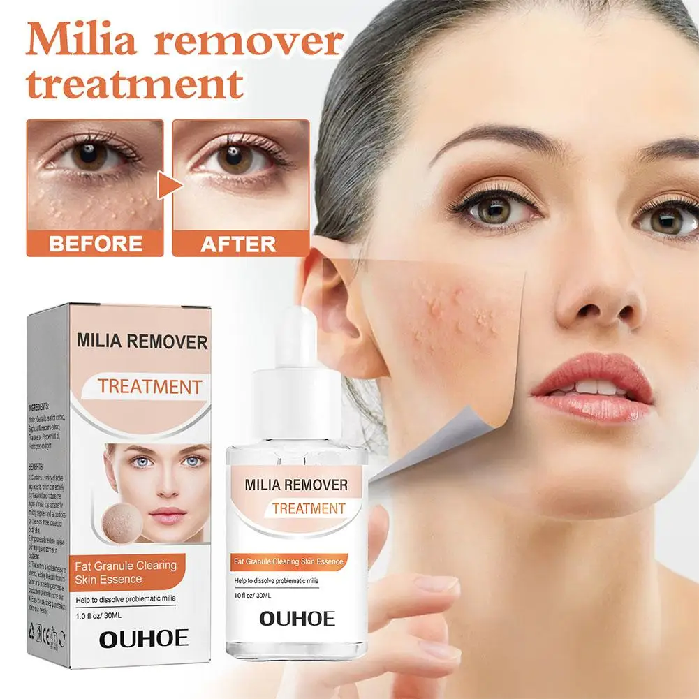 30ml Milia Clearing Essence Remover Essence Fat Granule Essence Acne Under Serum Skin Anti Eye Milia Clearing Anti Repair A J0G6